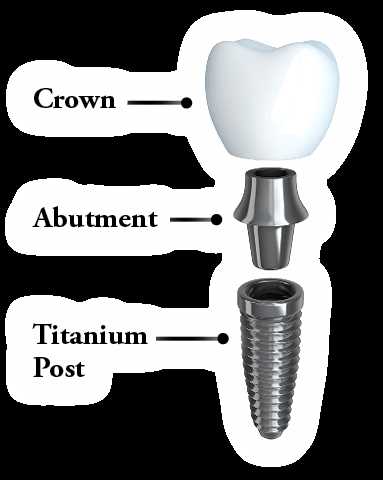 dental implant parts diagram dental implant parts diagram
