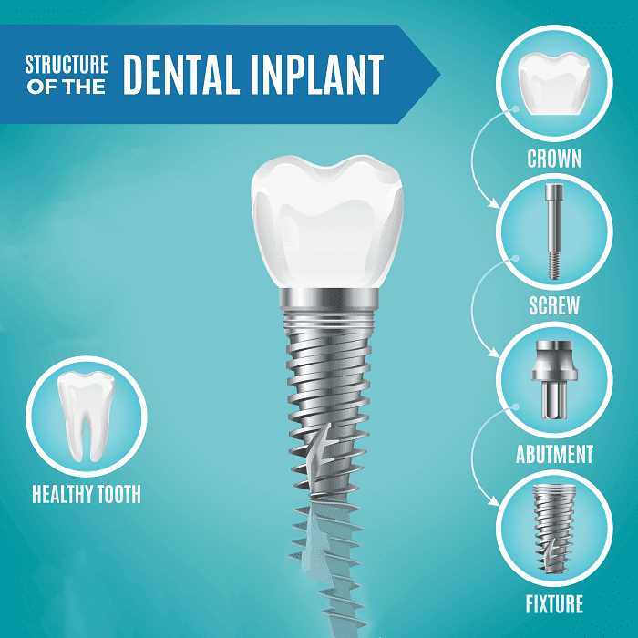 dental implant parts diagram dental implant parts diagram